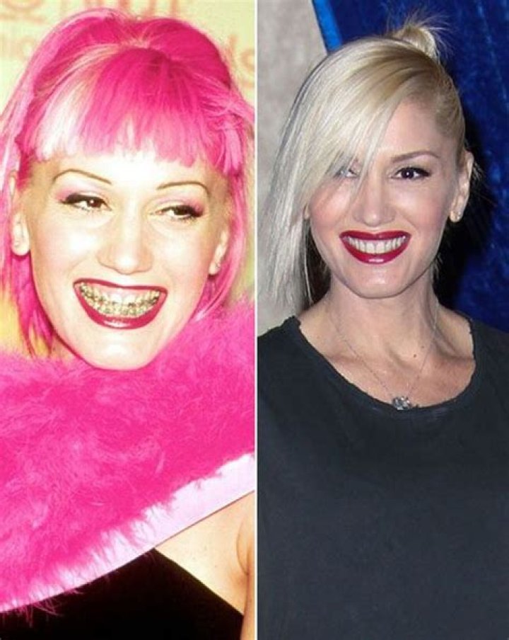 Has Gwen Stefani Ever Had Braces?